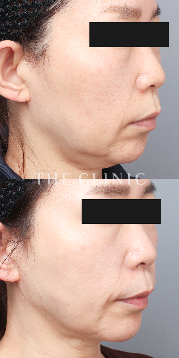 頰／顎のベイザー脂肪吸引（53歳女性）の術前・術後写真