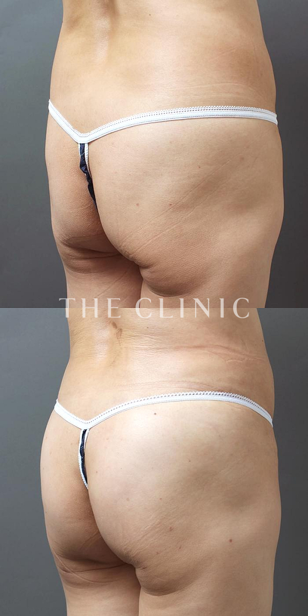 お尻・ヒップアップのヒップメイク by 360脂肪吸引®（56歳女性）の術前・術後写真