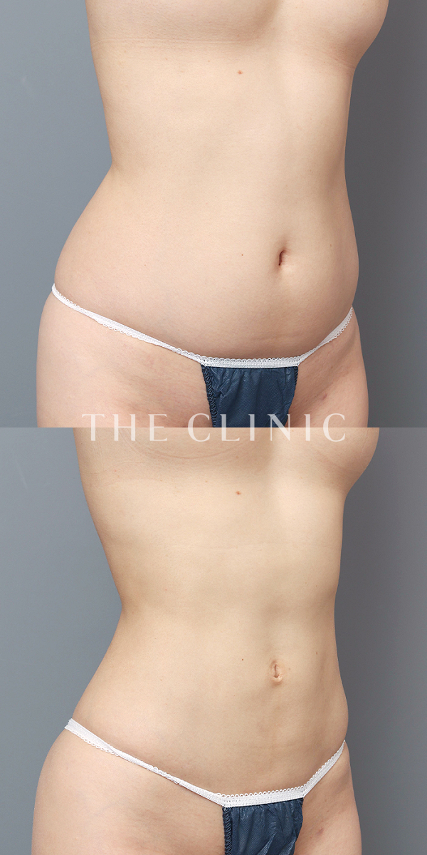 腰・ウエストのベイザー脂肪吸引（33歳女性）の術前・術後写真
