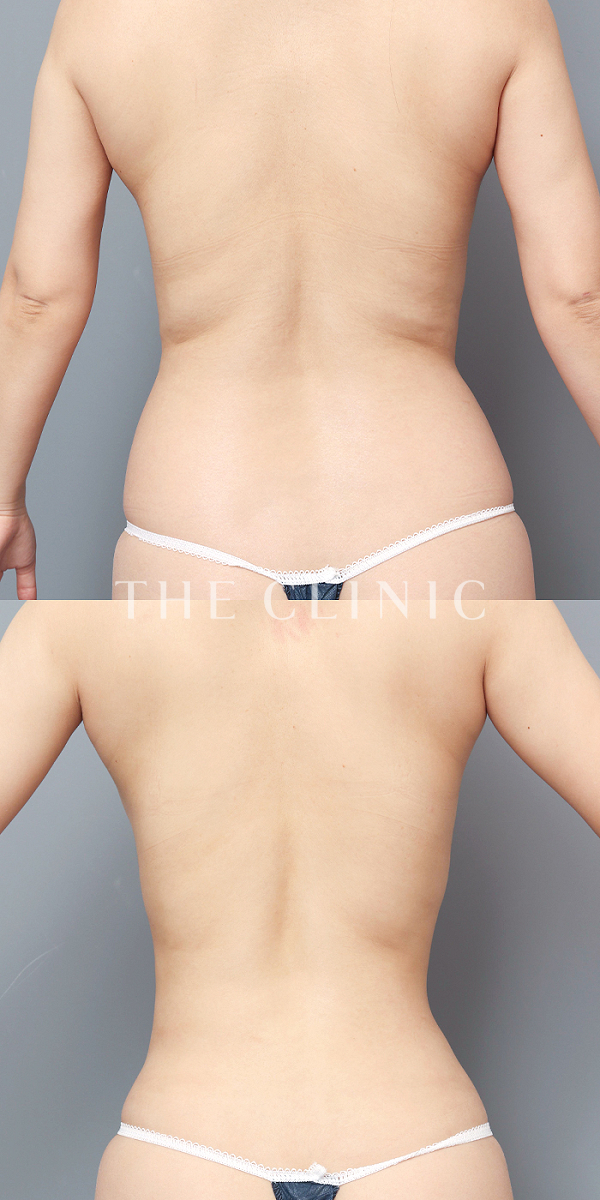 腰・ウエストのベイザー脂肪吸引（33歳女性）の術前・術後写真