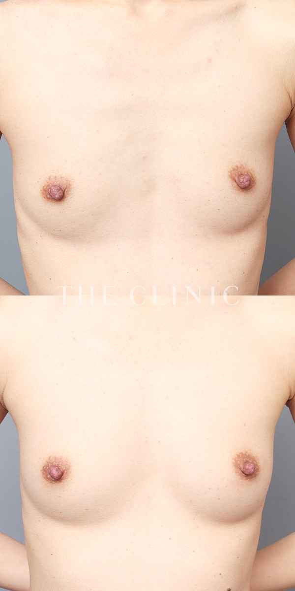 ボリュームアップのコンデンスリッチ豊胸（32歳女性）の術前・術後写真