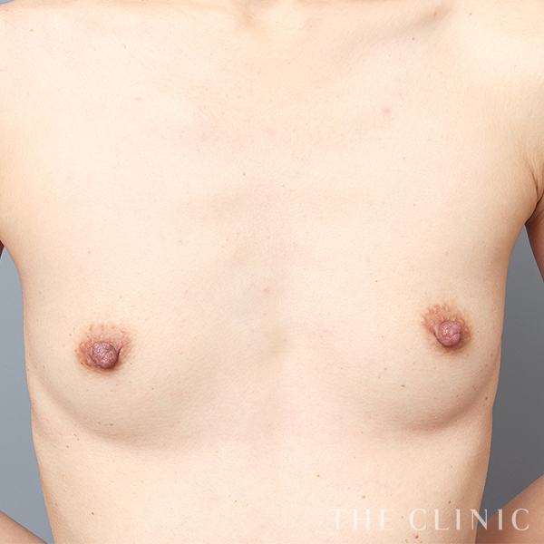 ボリュームアップのコンデンスリッチ豊胸（32歳女性）の術前写真