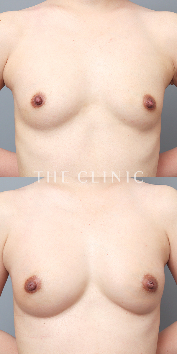 ボリュームアップのコンデンスリッチ豊胸（32歳女性）の術前・術後写真