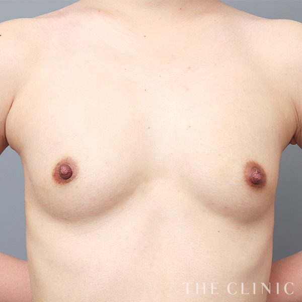 ボリュームアップのコンデンスリッチ豊胸（32歳女性）の術前写真