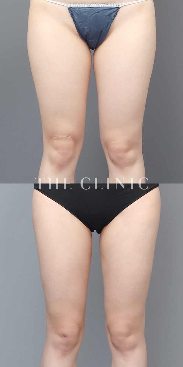 太もものベイザー脂肪吸引（29歳女性）の術前・術後写真