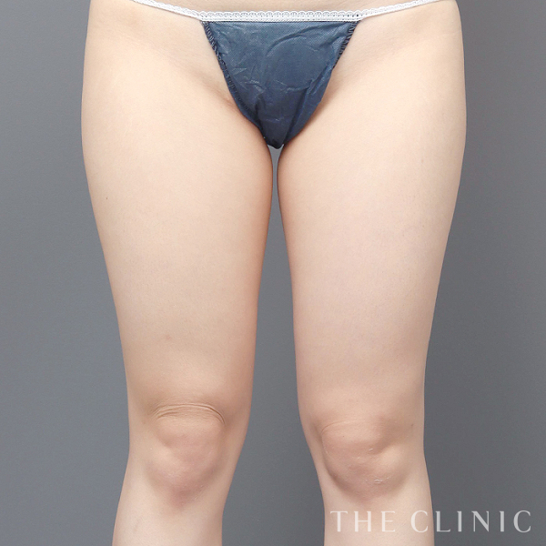 太もものベイザー脂肪吸引（29歳女性）の術前写真