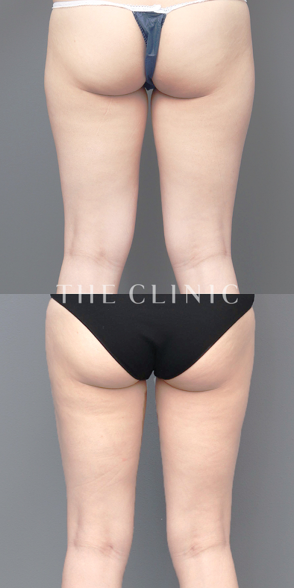 太もものベイザー脂肪吸引（29歳女性）の術前・術後写真