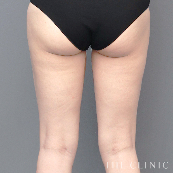 太もものベイザー脂肪吸引（29歳女性）の術後写真