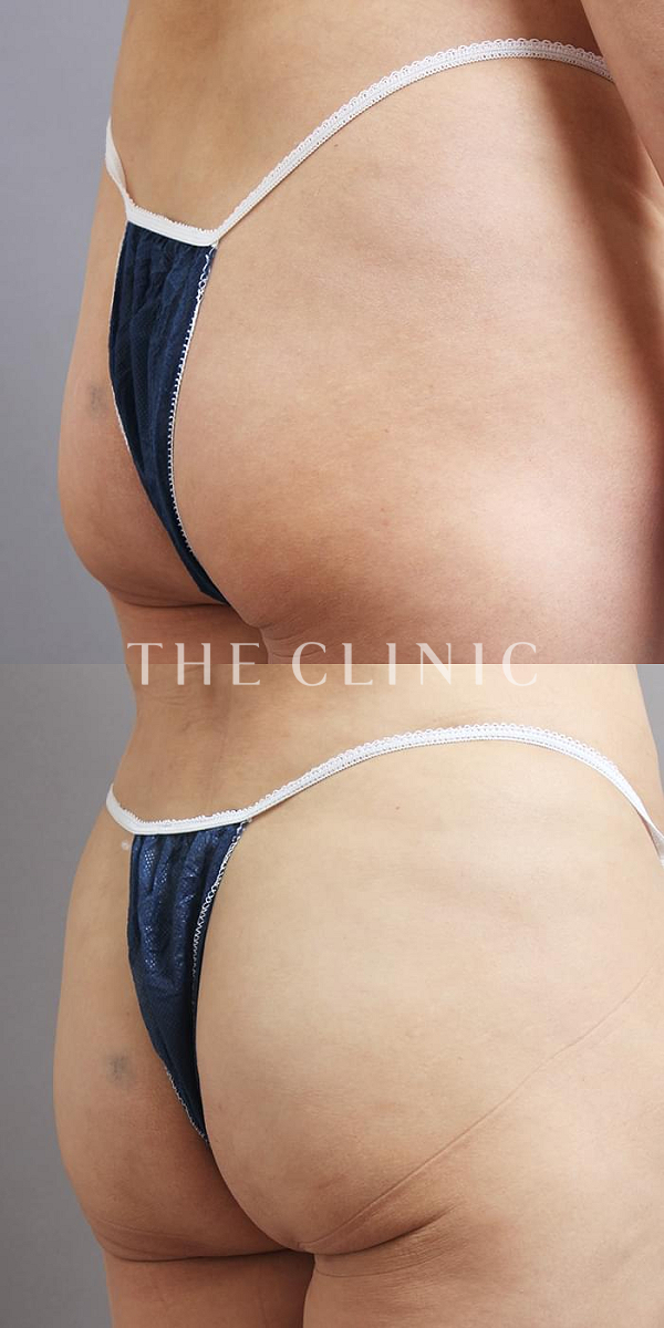 お尻・ボリュームアップ・ヒップアップのヒップメイク by 360脂肪吸引®（53歳女性）の術前・術後写真