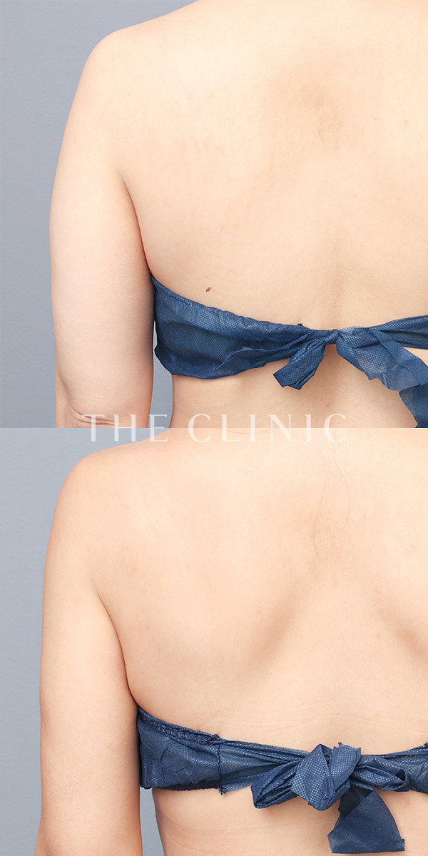 二の腕のベイザー脂肪吸引（37歳女性）の術前・術後写真