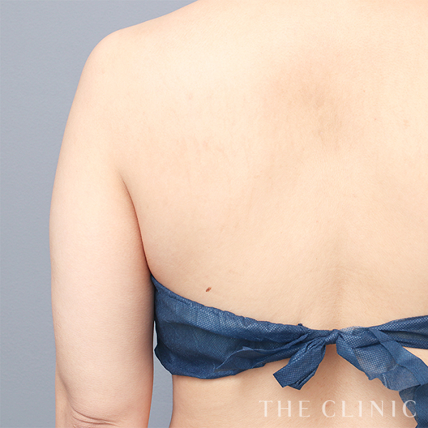 二の腕のベイザー脂肪吸引（37歳女性）の術前写真