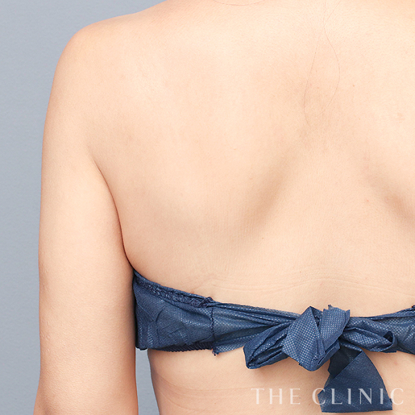 二の腕のベイザー脂肪吸引（37歳女性）の術後写真