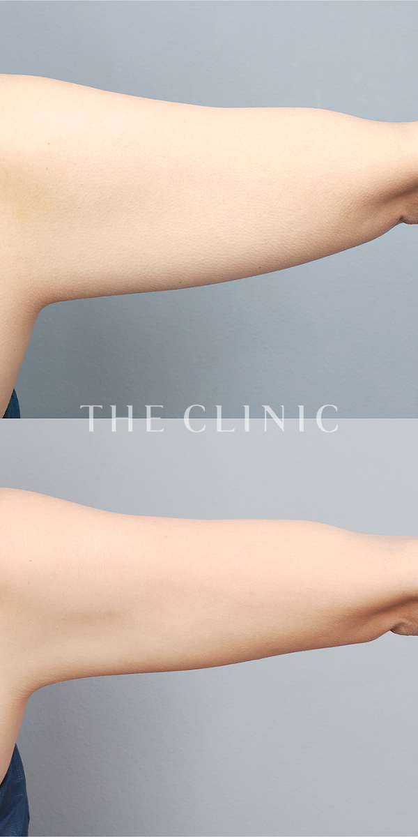 二の腕のベイザー脂肪吸引（37歳女性）の術前・術後写真