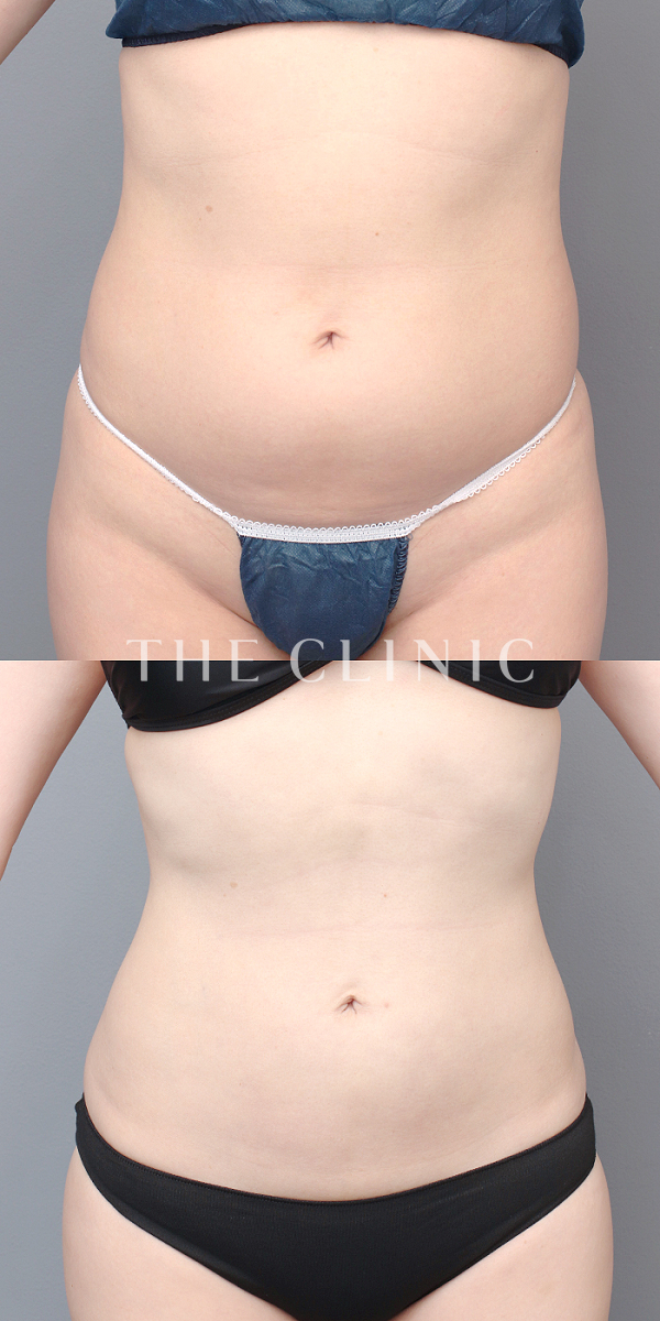 腹部のベイザー脂肪吸引（34歳女性）の術前・術後写真
