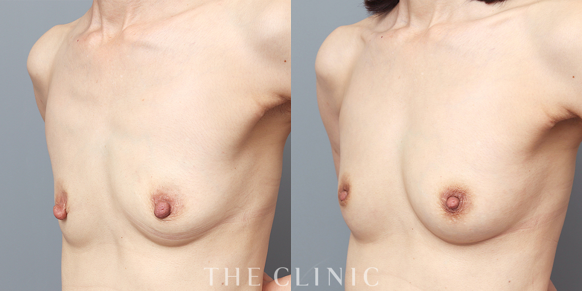 コンデンスリッチ豊胸の術前／術後