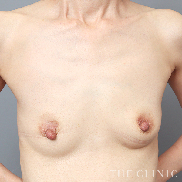 授乳後のたるみ・ボリュームアップのコンデンスリッチ豊胸（51歳女性）の術前写真