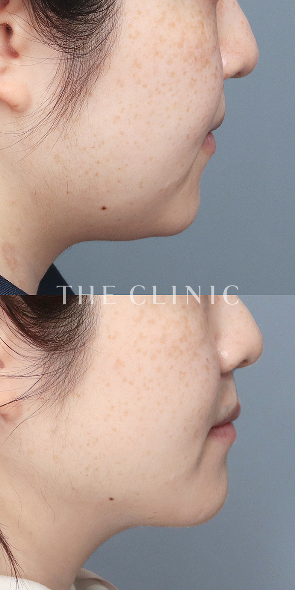 頰／顎のベイザー脂肪吸引（27歳女性）の術前・術後写真