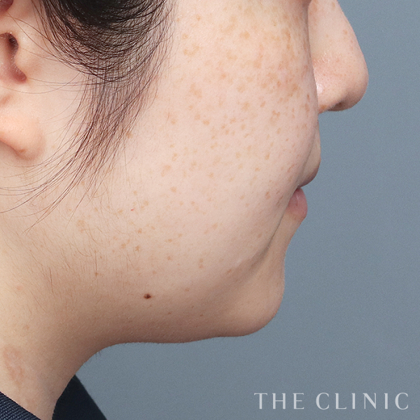 頰／顎のベイザー脂肪吸引（27歳女性）の術前写真