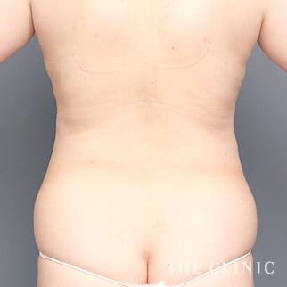 背中/腰・ウエストのベイザー脂肪吸引のモニター(50代)術前症例画像