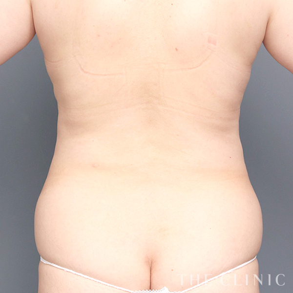 背中・腰・ウエストのベイザー脂肪吸引（50歳女性）の術前写真