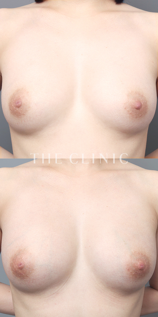 ボリュームアップのエクソソーム豊胸（29歳女性）の術前・術後写真