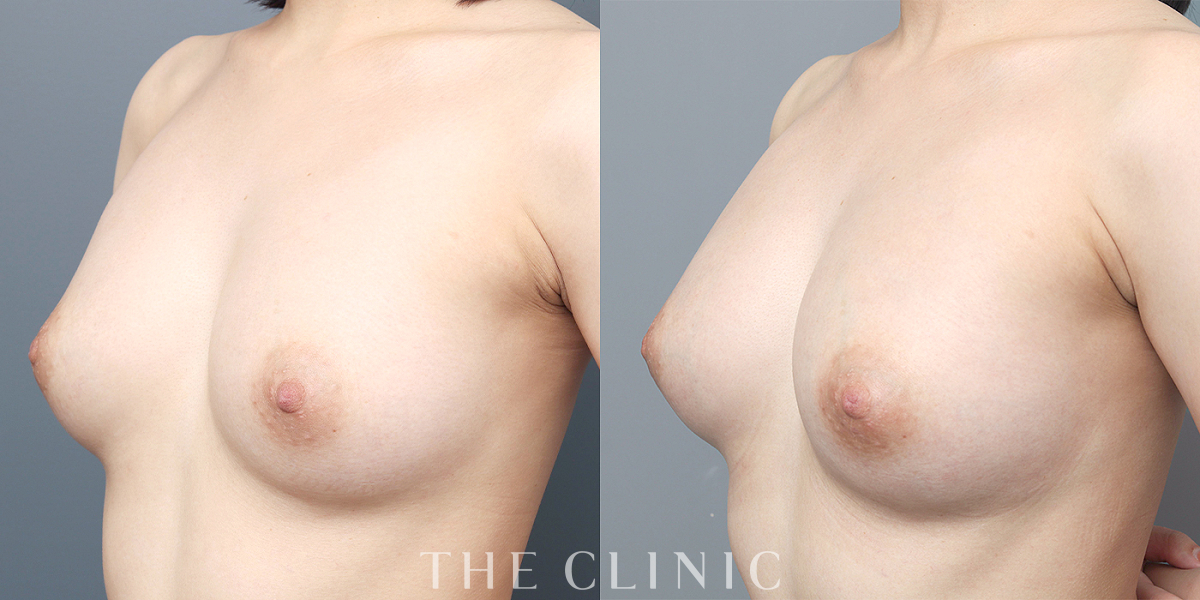 エクソソーム豊胸の術前／術後