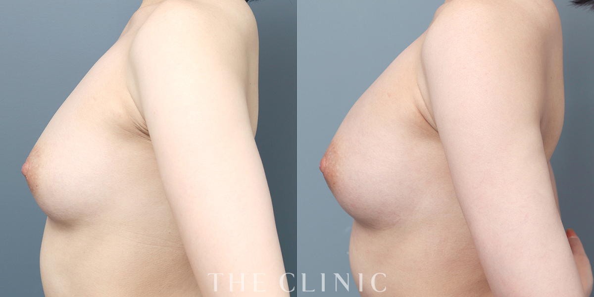 エクソソーム豊胸の術前／術後