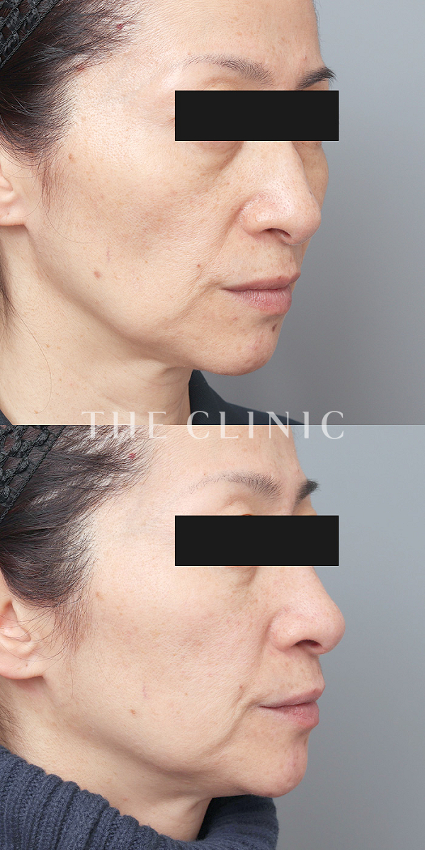 こけた頬のコンデンスリッチフェイス(顔の脂肪注入)（51歳女性）の術前・術後写真