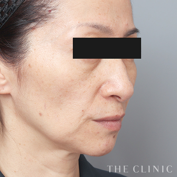 こけた頬のコンデンスリッチフェイス(顔の脂肪注入)（51歳女性）の術前写真