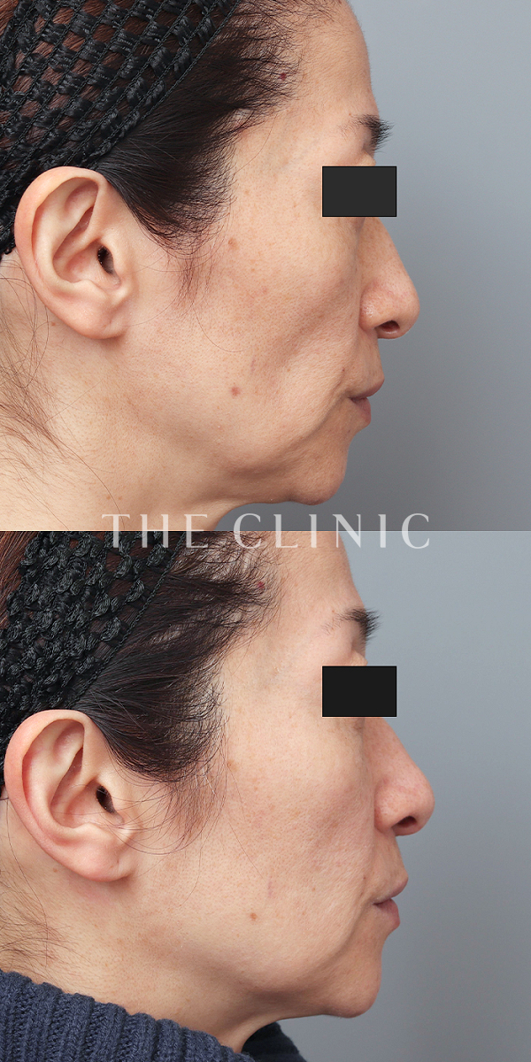 こけた頬のコンデンスリッチフェイス(顔の脂肪注入)（51歳女性）の術前・術後写真