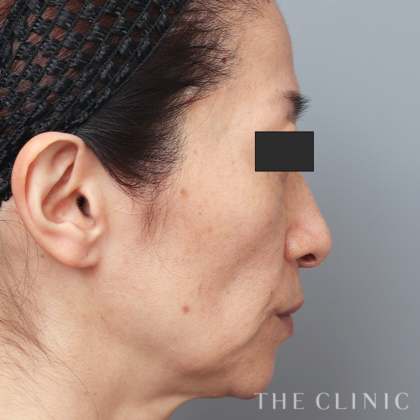 こけた頬のコンデンスリッチフェイス(顔の脂肪注入)（51歳女性）の術前写真