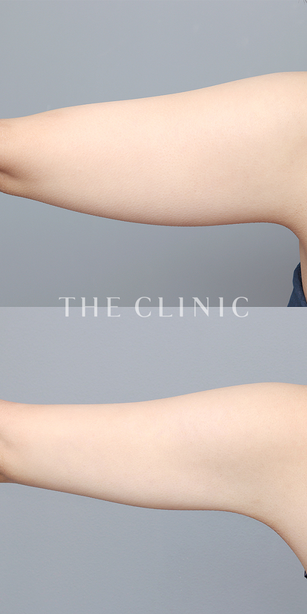 二の腕のベイザー脂肪吸引（22歳女性）の術前・術後写真