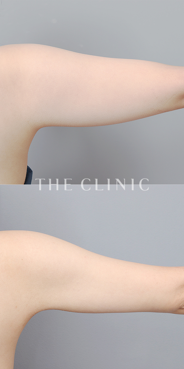二の腕のベイザー脂肪吸引（22歳女性）の術前・術後写真