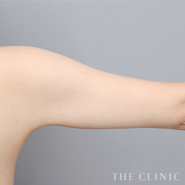 二の腕のベイザー脂肪吸引（22歳女性）の術後写真