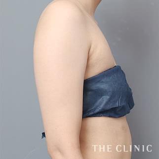 【THE CLINIC 症例画像】No.1383_1_二の腕_ベイザー脂肪吸引(執刀医:今西 理也)
