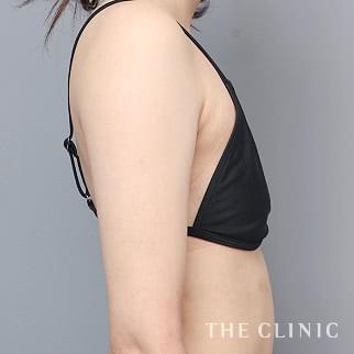 【THE CLINIC 症例画像】No.1383_2_二の腕_ベイザー脂肪吸引(執刀医:今西 理也)