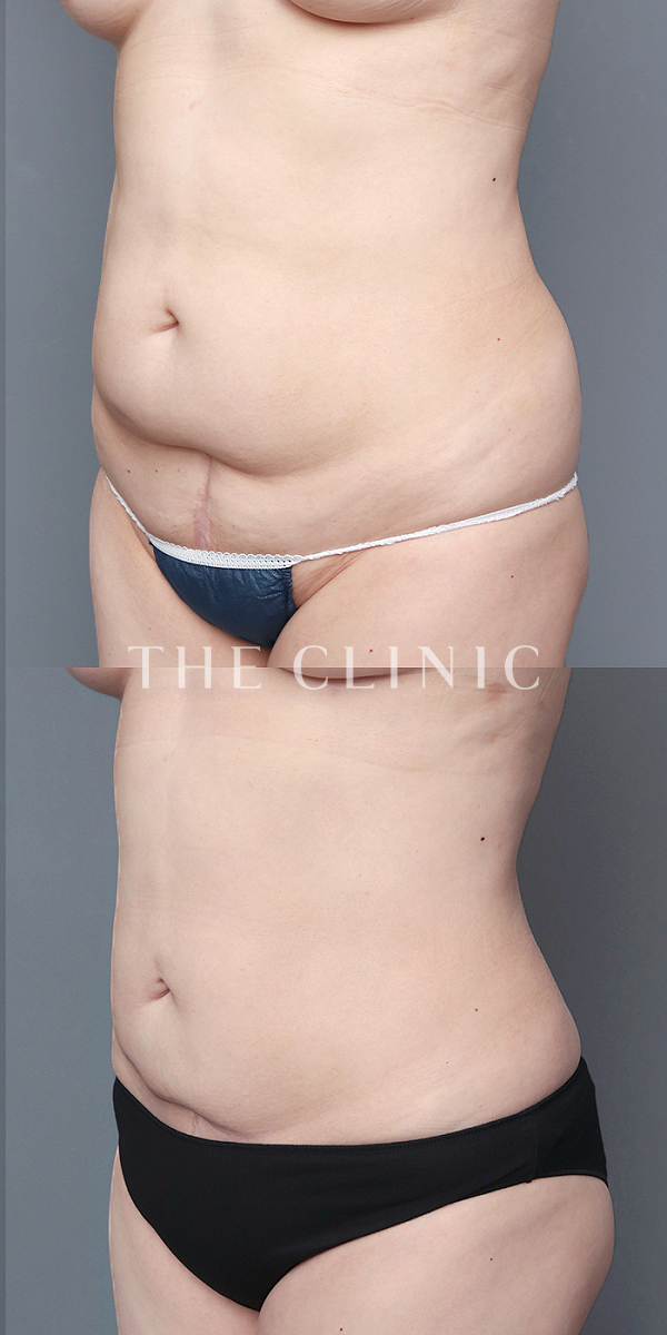 腹部のベイザー脂肪吸引（50歳女性）の術前・術後写真