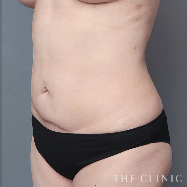 腹部のベイザー脂肪吸引（50歳女性）の術後写真