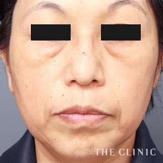 【THE CLINIC 症例画像】No.1390_1_目の下のクマ_マイクロCRF注入(顔の脂肪注入)(執刀医:村田 八千穂)