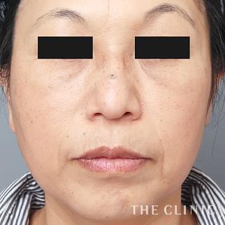 【THE CLINIC 症例画像】No.1390_2_目の下のクマ_マイクロCRF注入(顔の脂肪注入)(執刀医:村田 八千穂)