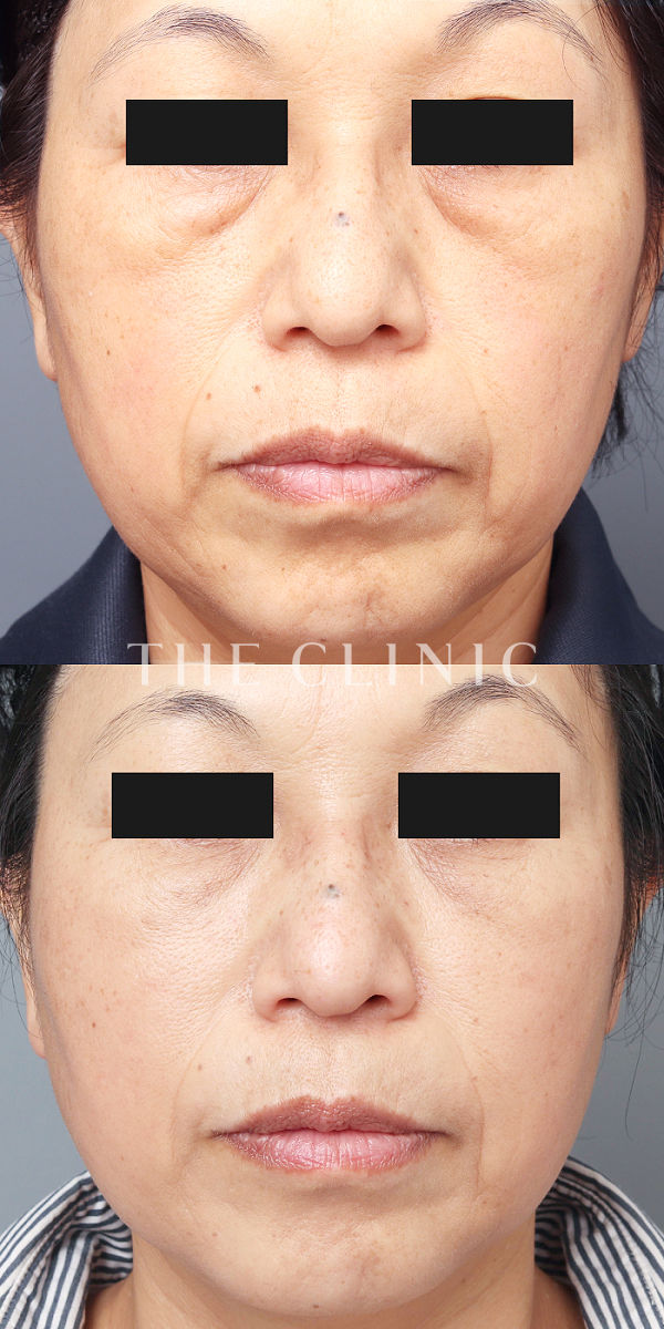 目の下のクマのマイクロCRF注入(顔の脂肪注入)（53歳女性）の術前・術後写真