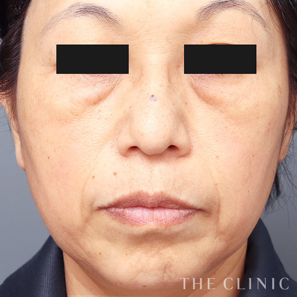 目の下のクマのマイクロCRF注入(顔の脂肪注入)（53歳女性）の術前写真