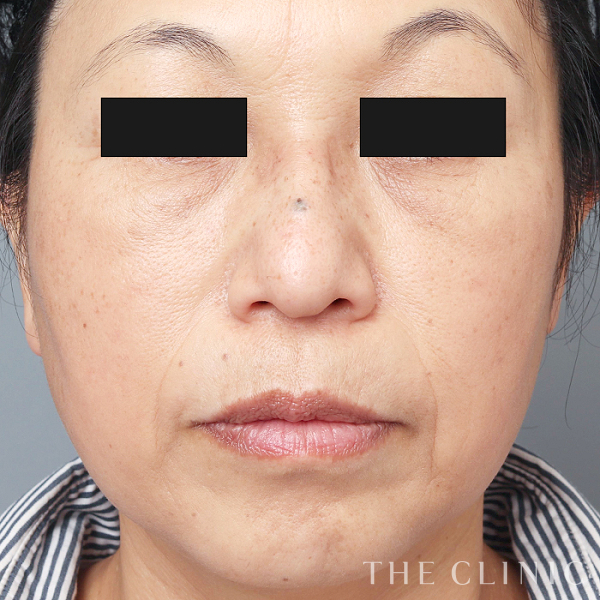 目の下のクマのマイクロCRF注入(顔の脂肪注入)（53歳女性）の術後写真