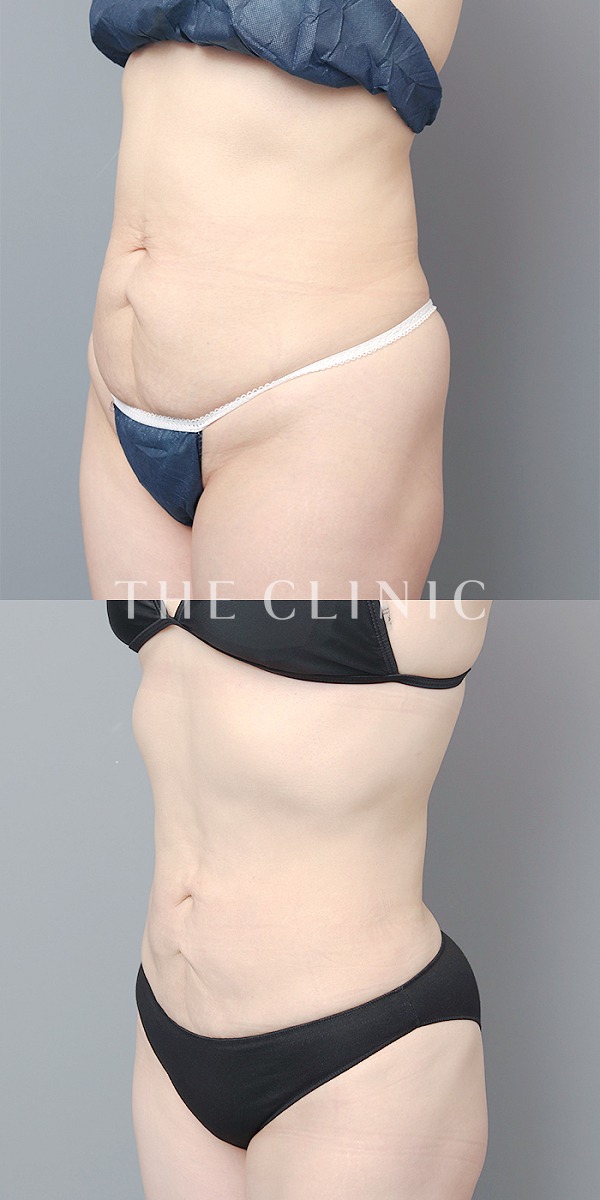 腹部のベイザー脂肪吸引（48歳女性）の術前・術後写真