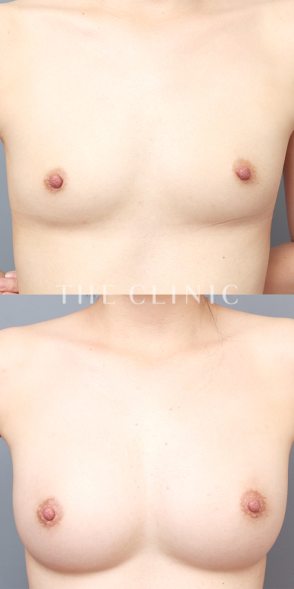 ボリュームアップのコンデンスリッチ豊胸（32歳女性）の術前・術後写真