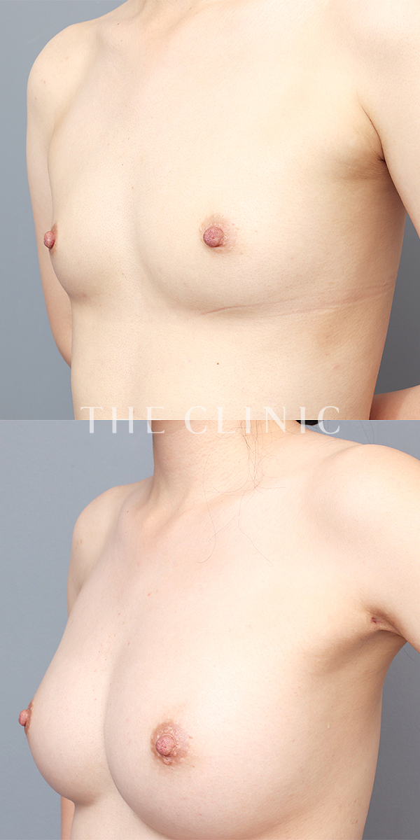 ボリュームアップのコンデンスリッチ豊胸（32歳女性）の術前・術後写真