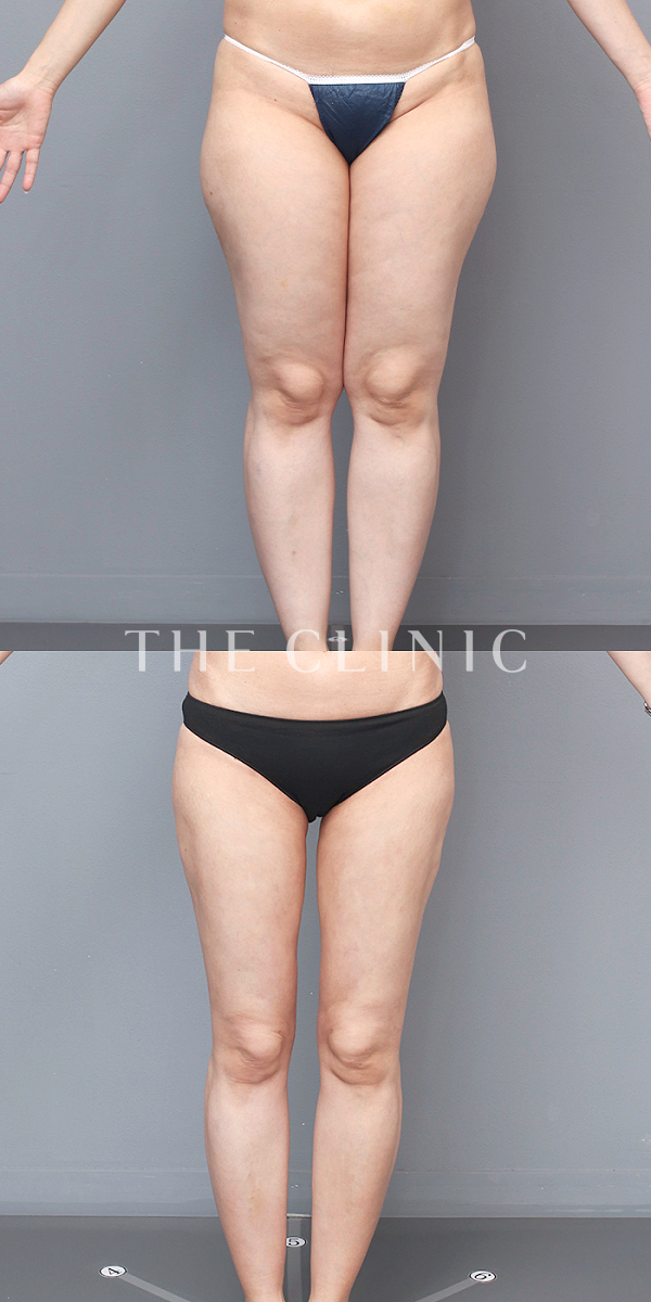 太もものベイザー脂肪吸引（46歳女性）の術前・術後写真