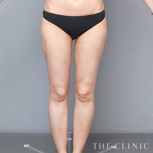 太もものベイザー脂肪吸引（46歳女性）の術後写真