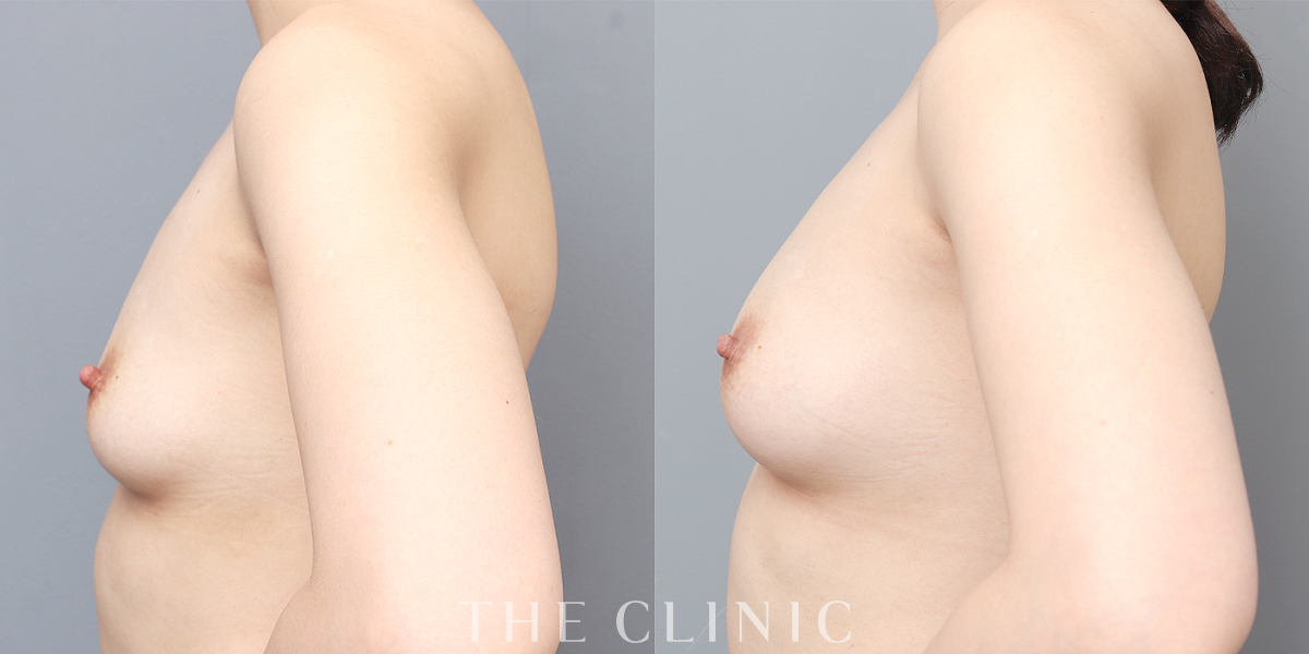コンデンスリッチ豊胸の術前／術後
