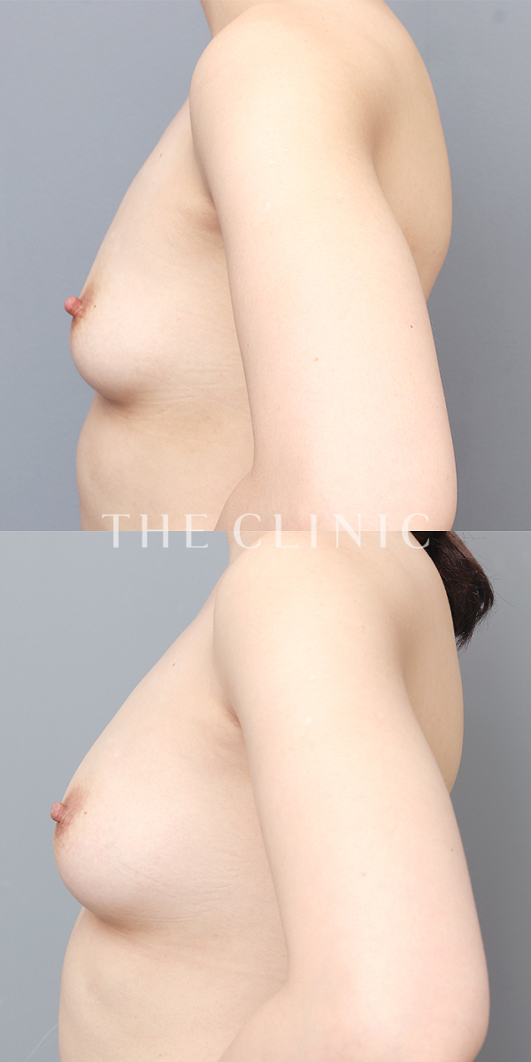 ボリュームアップのコンデンスリッチ豊胸（30歳女性）の術前・術後写真